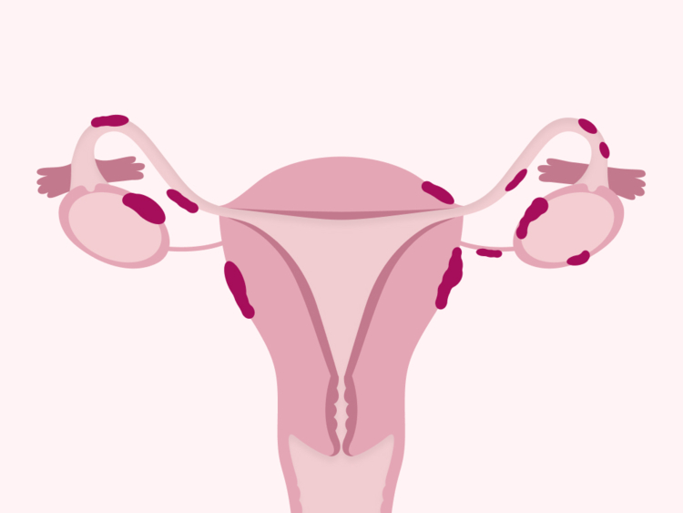 The different endometriosis treatment options explained
