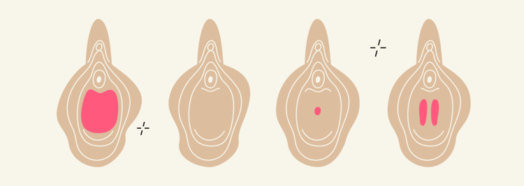 Septate Hymen: What It Is and How a Hymenectomy Helps