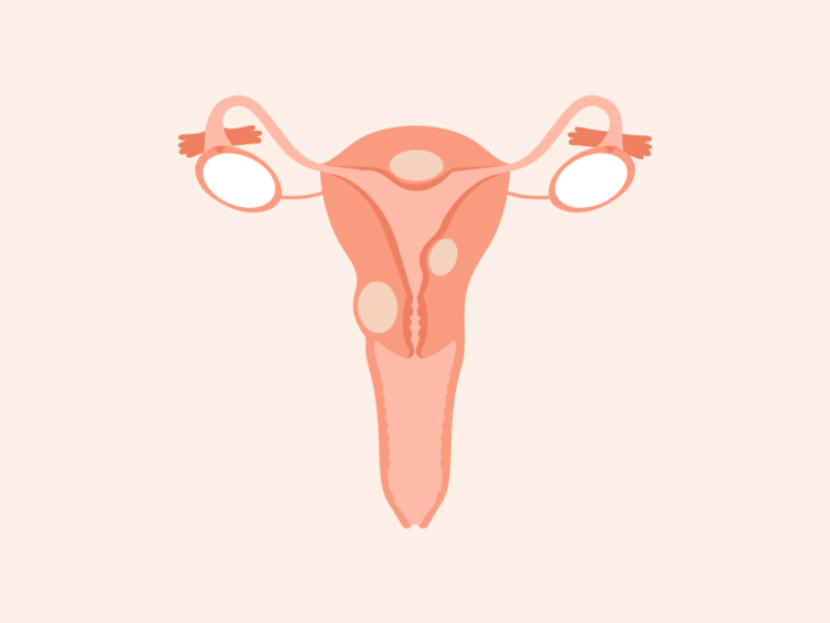 Fibroids: What do they feel like, and do they go away?