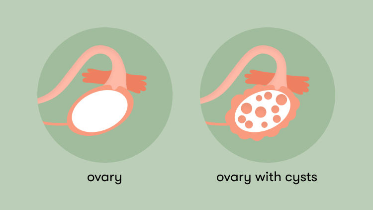 PCOS quiz: How much do you know about polycystic ovary syndrome?