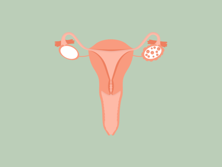a diagram of a uterus with polycystic ovaries (PCOS)