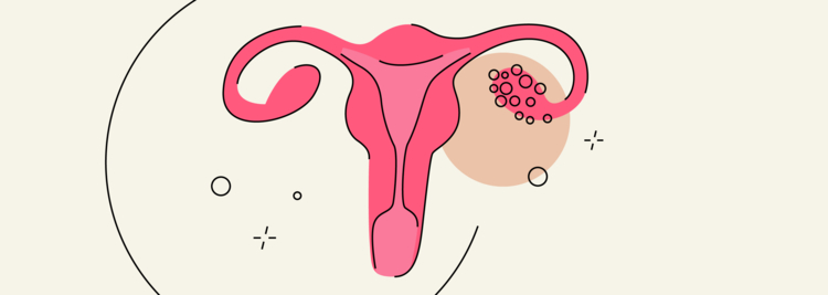 Polycystic Ovary Syndrome: Symptoms, Risk Factors & Treatment