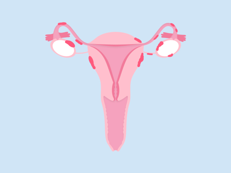 PCOS und Endometriose: Was sind die Unterschiede?