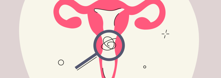 What Is Cervicitis? Top FAQs and Much More